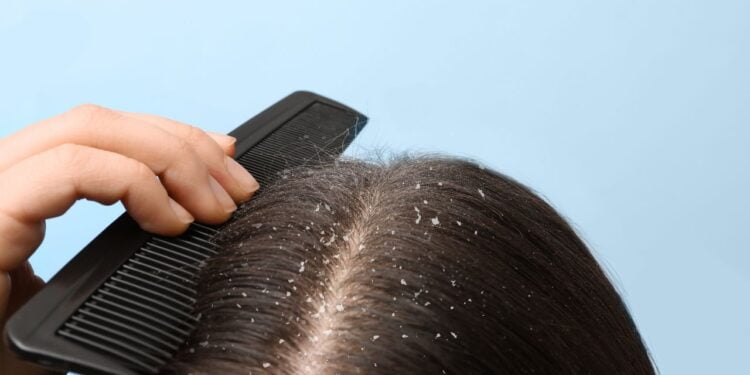 receitas caseiras para caspa