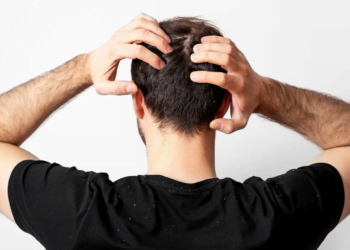 dicas para acabar com a caspa