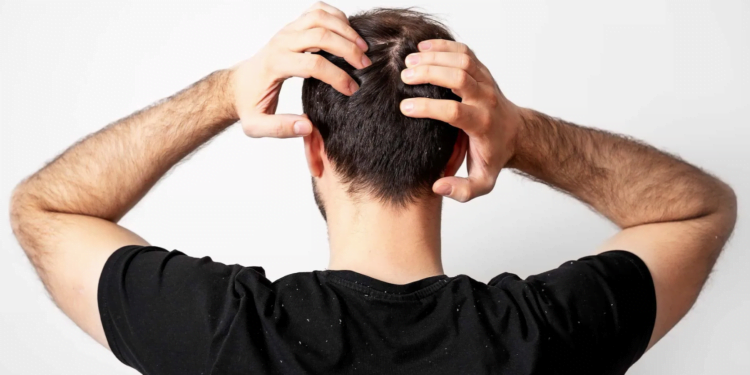 dicas para acabar com a caspa