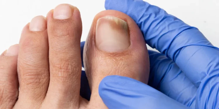 Descubra quais remédios caseiros ELIMINAM fungos nas unhas