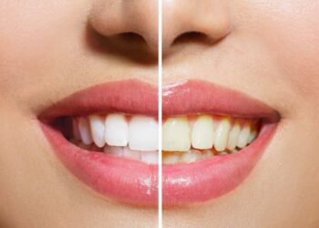 DENTES MAIS BRANCOS: Confira dicas caseiras para um sorriso iluminado