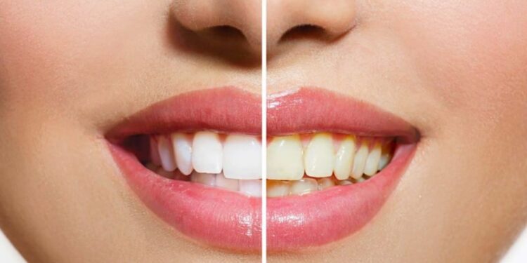 DENTES MAIS BRANCOS: Confira dicas caseiras para um sorriso iluminado
