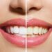 DENTES MAIS BRANCOS: Confira dicas caseiras para um sorriso iluminado