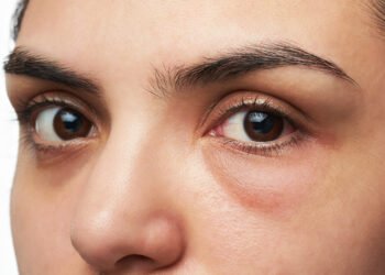 OLHEIRAS: 10 dicas práticas para elimina-las