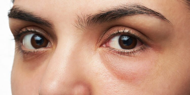 OLHEIRAS: 10 dicas práticas para elimina-las