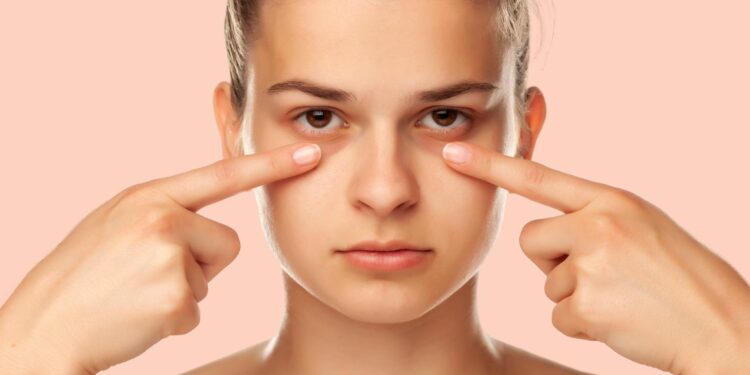 como eliminar olheiras